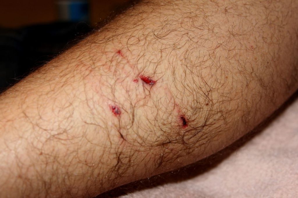 What to Do After A Dog Bite? Dog