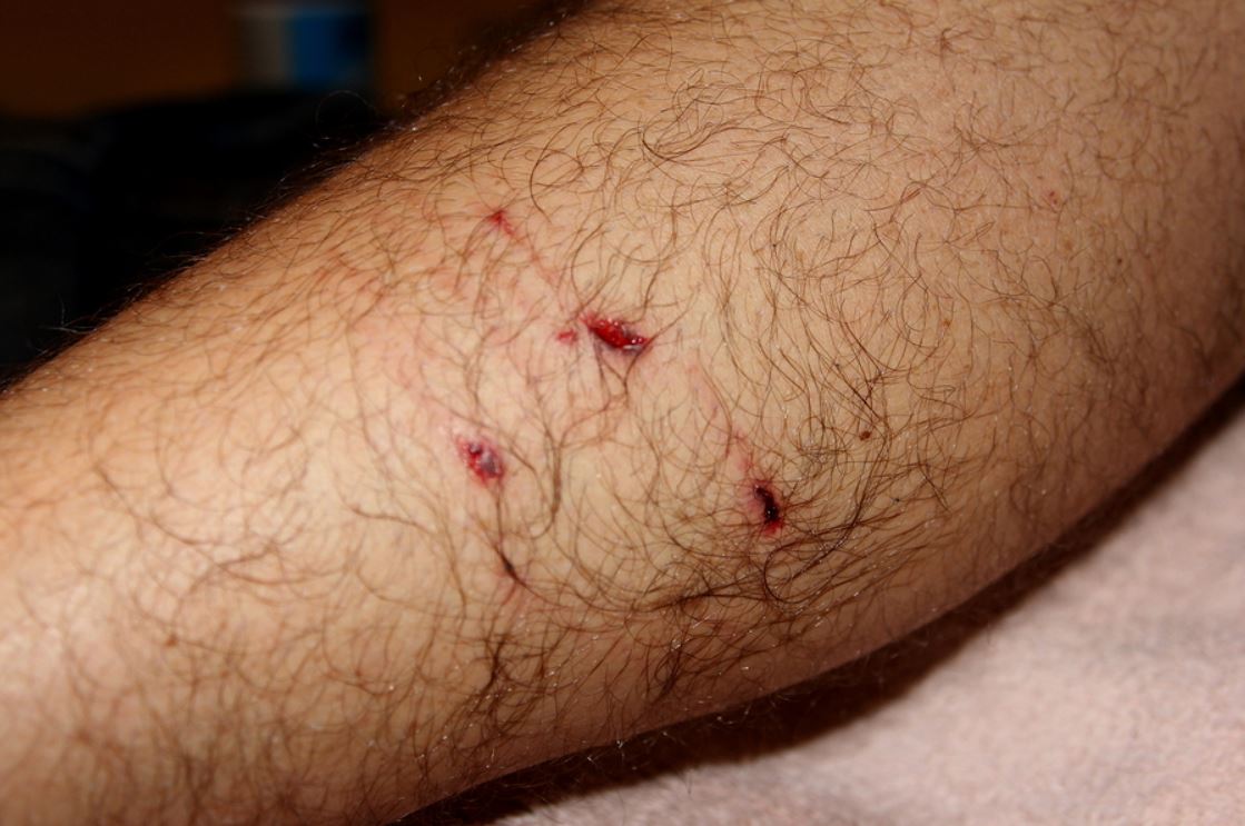 What to Do After A Dog Bite? Dog